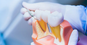 Read more about the article 為什麼植牙需要補骨？常見的骨粉種類有哪些？