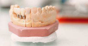 植牙失敗的常見原因與預防方法