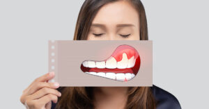 牙齦為什麼會萎縮，常見原因為何？