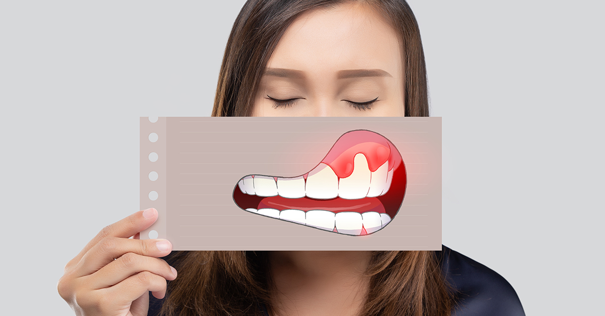 You are currently viewing 牙齦為什麼會萎縮，常見原因為何？
