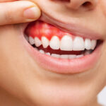 牙齦萎縮的原因與治療方式