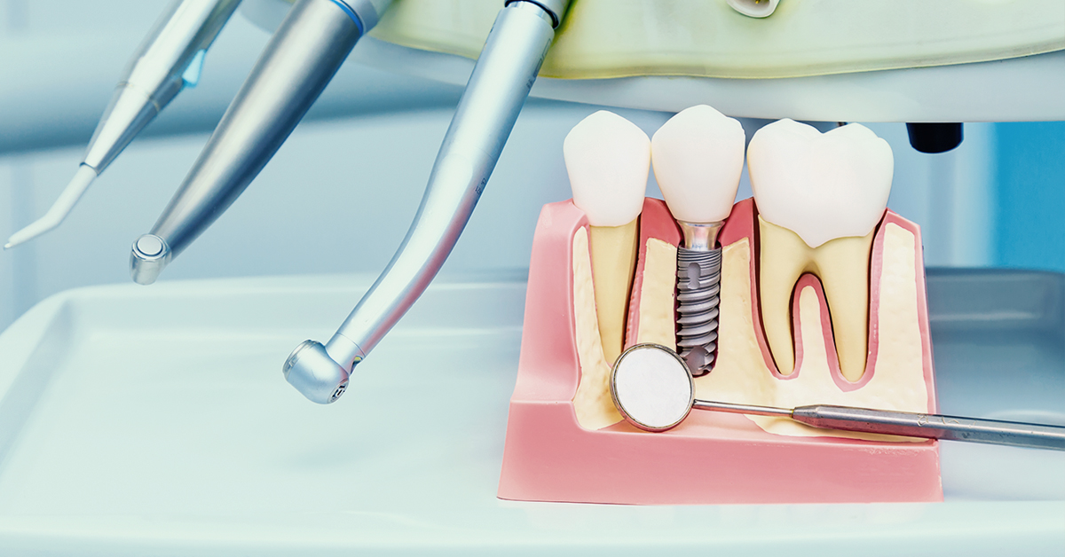 You are currently viewing 現代化牙科幫您降低植牙風險，提升治療品質