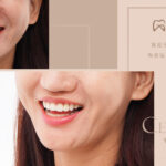 李悅芳醫師陶瓷貼片前牙美學案例
