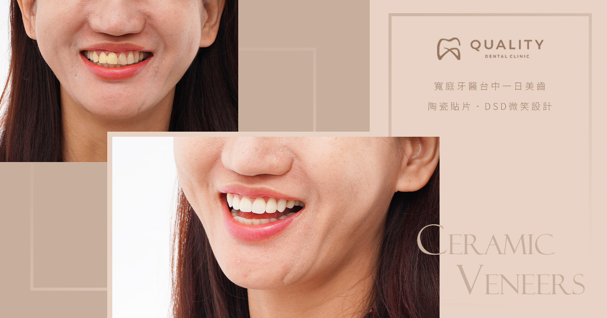 李悅芳醫師陶瓷貼片前牙美學案例
