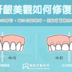 牙齦美觀如何治療？牙根覆蓋式與牙冠增長術