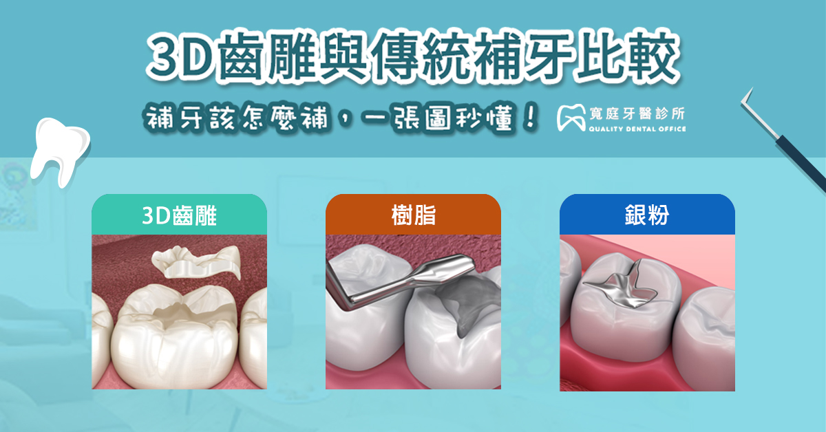 常見的補牙方式比較