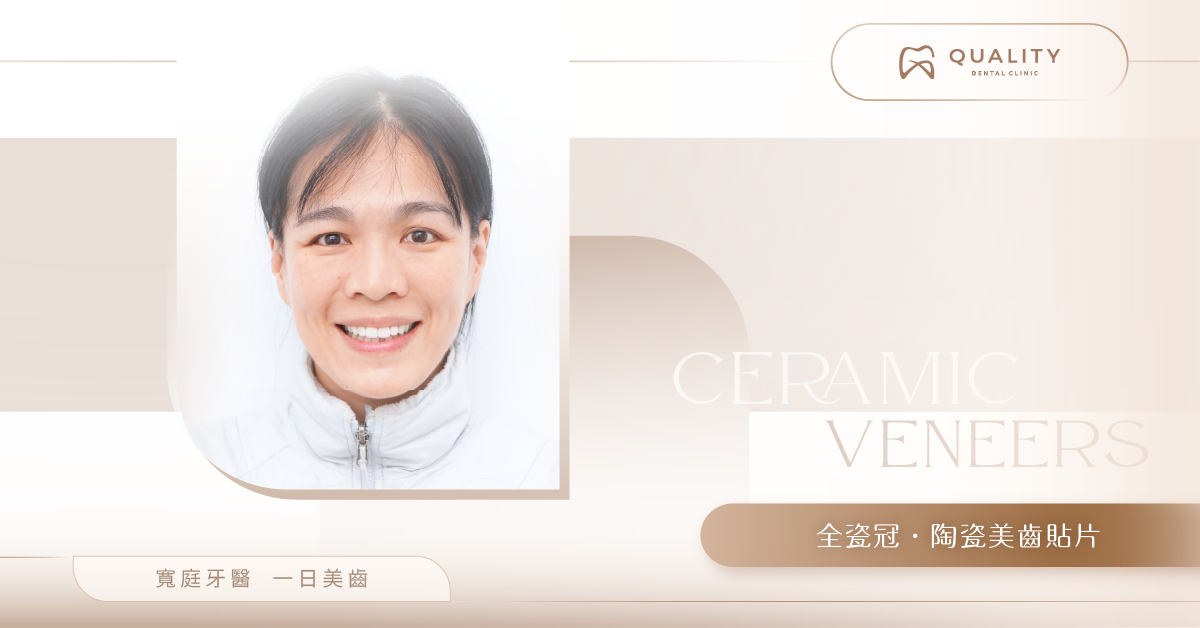 根管治療後怎麼保護？陶瓷貼片與全瓷冠來幫忙